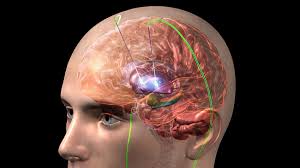 Aborda la estimulación cerebral profunda como alternativa de mejora ante el Parkinson