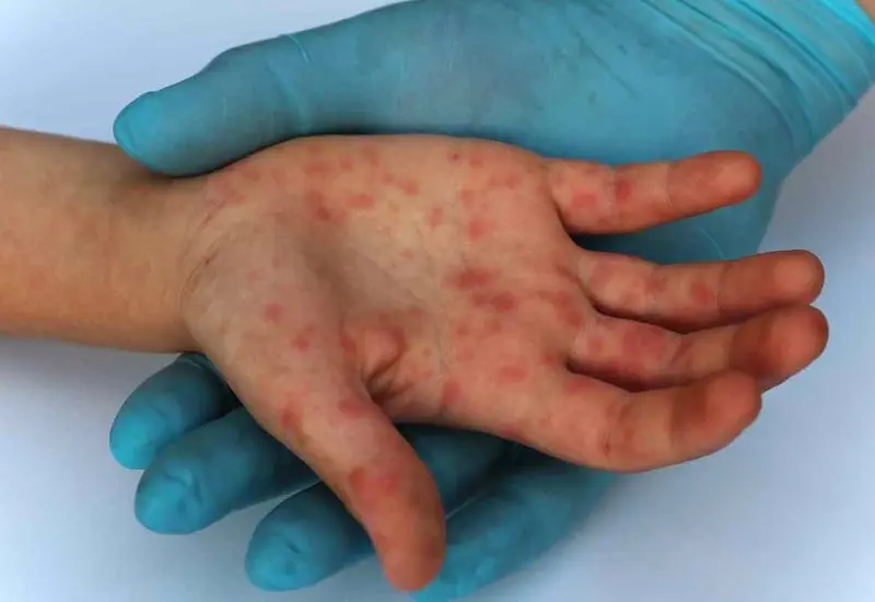 Convoca Jurisdicción Sanitaria a completar vacunación contra sarampión en Mixteca