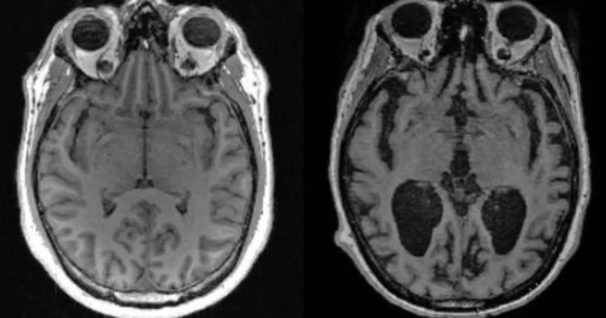 Descubre Harvard avance con litio contra Alzheimer