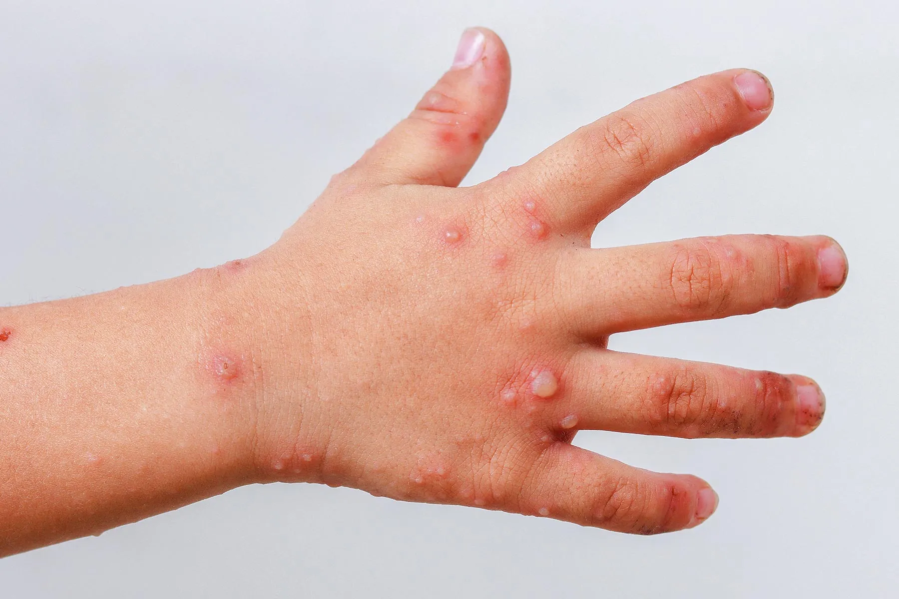 Refuerza SSO acciones preventivas ante casos de virus Coxsackie