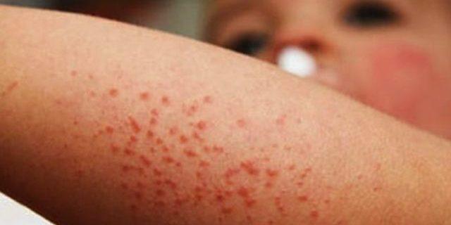 Reporta Oaxaca 753 casos de virus Coxsackie en menores de edad
